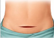 Open Tubectomy